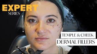 Temple and Cheek Dermal Fillers Treatment | Expert BTS 2023