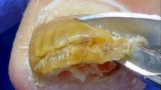 Cleaning a pair of thick onychomycosis, it feels so comfortable to remove nails【Doctor Liu Pedicure】
