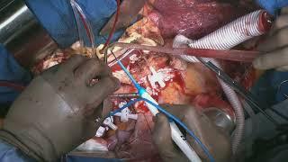 Thoracoabdominal aortic replacement with removing stent graft,