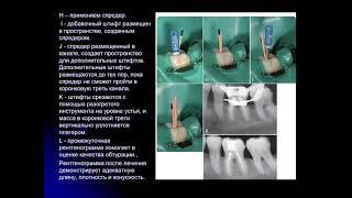 Эндодонтия 6.Методы обтурации корневых каналов зуба