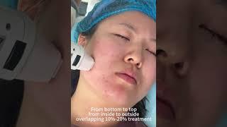 How to Use GlowSkin Neo Golden RF Microneedling & Fractional RF