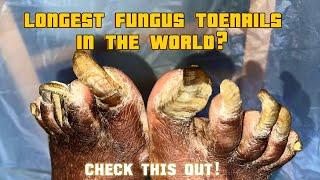 Extremely fungal thickened toenails I Onychogryphosis Transformation: Trust Your Podiatrist