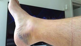 Achilles Tendon Recovery #1-non-surgical, early weight bearing option