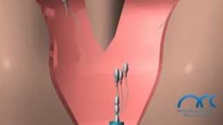 IUI Treatment Procedure | Intra Uterine Insemination Process in India - ARC Rsearch Centre Chennai