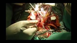 Surgical correction of DORV