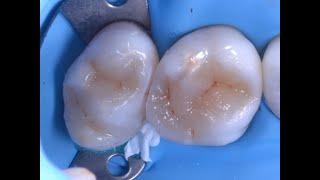 Сaries treatment, direct composite 26 27 tooth