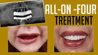 All-on-4 Dental Implants: Watch This Before You Decide!