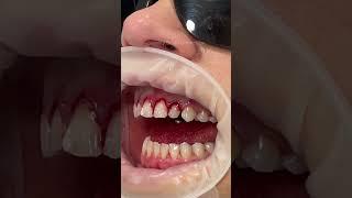 This technique is known as a gum lift, gum contouring or gum augmentation 