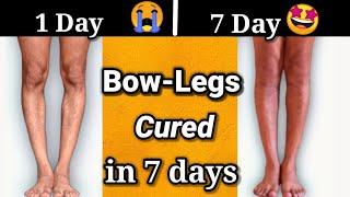 Bow leg problem solution with EXERCISES in 7 days