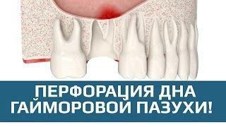 Хирургическая стоматология. Перфорация дна гайморовой пазухи