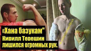 РУКИ БАЗУКИ АМПУТАЦИЯ! !! КИРИЛЛ ТЕРЕШИН БЕЗ РУК! УЖАС