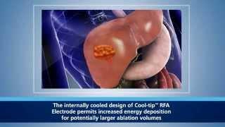 Система радиочастотной абляции CoolTip