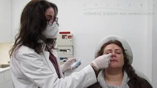 RHA 4 | HA Injectable Facial Filler Treatment | Chicago Cosmetic Surgery and Dermatology