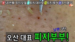 피지 직접 뽑아드렸습니다 _ 피지제거 블랙헤드제거 피지뽑기 _  오산 피지부부 먼저 남편 피지짱 먼저 피지를 박살냈습니다 3탄