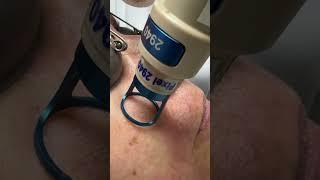 MANCHAS E CICATRIZES DE ACNE COM LASER PIXEL FACIAL
