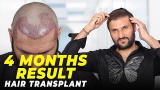 Hair Transplant in Indore | Best Results & Cost of Hair Transplant in Indore