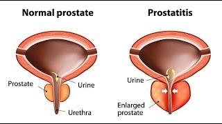 Prostatitis