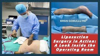 Liposuction Surgery in Action: A Look Inside the Operating Room | Plastic Surgery