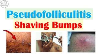 Pseudofolliculitis Barbae & Pubis (Shaving Bumps): Causes, Pathophysiology, Complications, Treatment