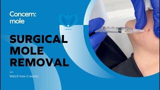 Mole Removal - Safe Surgical Procedure to Remove a Mole, Skin Tag, Wart | Fast Mole Surgery