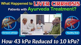 What Happened to Liver Cirrhosis Patients with Ayurveda Treatment? How 43 kPa Reduced to 10 kPa?