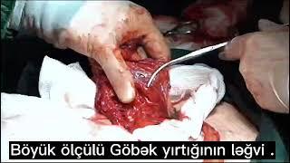 Böyük ölçülü Göbək yırtığı əməliyyatını canlı full izlə. dr.Ramil Nadirov suallarınızı cavablayır.