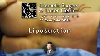 Liposuction + Reunion | Dr. Jabor | Cosmetic and Laser Surgery Centers of El Paso