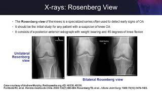 Knee Osteoarthritis: Examining the Evidence on Single-Injection Hyaluronic Acid