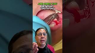 Simple & Painless Tooth Extraction Explained! | View Mobile Dental #shorts
