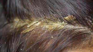 Dandruff scratching removal on head using black combing#117