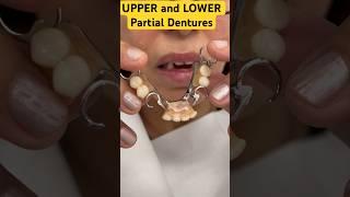 UPPER and LOWER Partial Dentures #youtubeshorts #shorts#viral