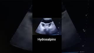 hydrosalpinx#medicalimaging #ultrasound #imaging #ultrasoundimaging #learning #