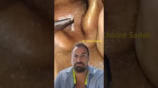 Massive blackhead extraction #skincare #blackheadremoval Dr Khaled Sadek