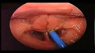 Adenoidectomy Surgery - Removal Of Adenoids - ENT Consultant London - ENT Surgeon London