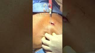 Creating a New Belly Button - The Kaplan Center -  NYC NJ #bellybutton #bodycontouring