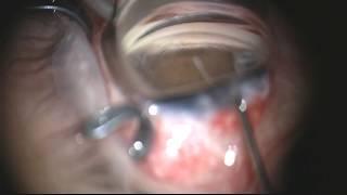 Bac Nguyen, MD: Kahook Dual Blade® (KDB) Prior Tube Shunt Case