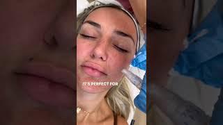 "No peel" Peel in Newport Beach - Skinsation OC