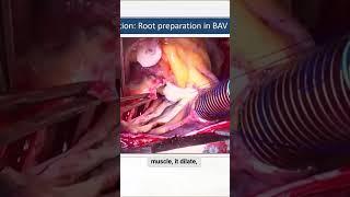 SCTS 2025 | Valve Sparing Aortic Root Replacement—Tips and Tricks #SCTS #valve #presentation