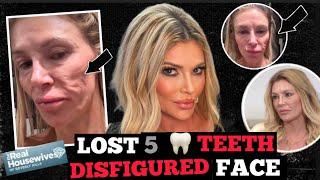 Brandi Glanville Claims Parasite Is Jumping Around In Her Face…lost 5 teeth