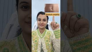 #stretchmarks#darkcircles#darkneck#darkspots#skincare#shorts#short#trending#ytshorts#youtubeshorts