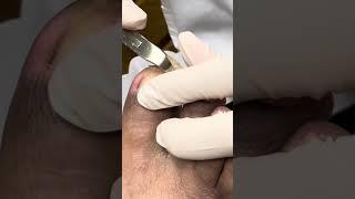 Extreme THICK Toenail Cutting on Diabetic Patient  | So Satisfying!