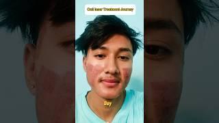 Co2 laser Treatment Journey || Acne Scar,Cut Mark Solution #laser #acnescars