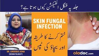 Skin Fungal Infection Treatment In Urdu/Hindi- Dad Khad Ka Ilaj - Skin Pe Fungus Kese Hota Hai