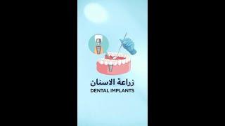 زراعة الأسنان | Dental Implants | Elite Medical Center مركز النخبة الطبي