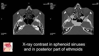 New Treatment for sinusitis. Yamik procedure- topical treatment of sinusitis