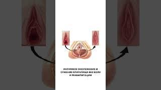 Интимное омоложение и сужение влагалища без боли и реабилитации