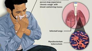 tuberculosis