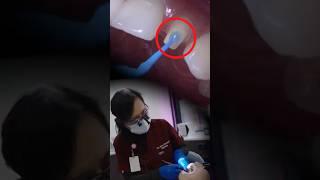 HOW TO Bond All-Ceramic Crown on a PEG Lateral #dentaltips