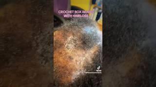 Crochet Box Braids With Alopecia/HairLoss #crochetbraids #hairstyles #crochetbraidstyles #hair