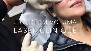 Juvederm Voluma XC by Dr. P. Alexander Ataii at Laser Clinique